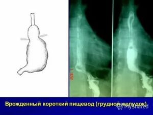 Чем опасен грудной желудок