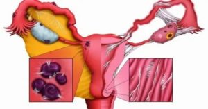 Можно ли беременеть при спайках яичников