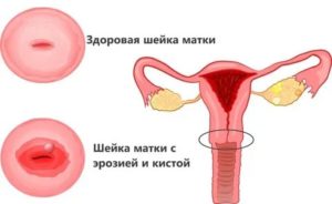 Можно ли беременеть если есть киста на шейке матки