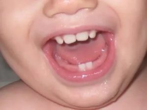 Почему растут кривые зубы у грудничков