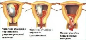 Как правильно лежать при отслойке плодного яйца