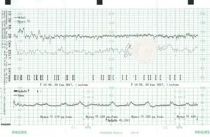 Как проводится ктг при двойне
