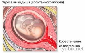 Чем помогает магнезия при угрозе выкидыша