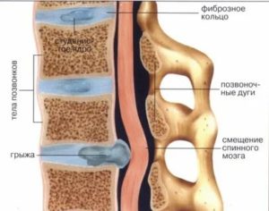 Что такое послеродовая грыжа позвоночника