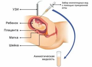 Что такое анализ на околоплодные воды и как он делается