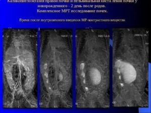 Что такое каликоэктазия почки у новорожденного