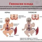 Можно ли грудному ребенку облепиховые свечи