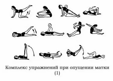 Можно ли качать пресс при опущении матки после родов