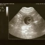 Кардиомагнил при планировании беременности для чего назначают