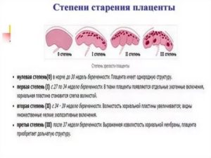 Как остановить раннее старение плаценты