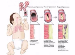 Сколько лечится обструктивный бронхит у грудничков