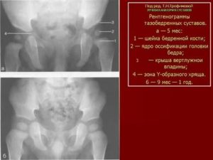 Что такое окостенение тазобедренных суставов у грудничков