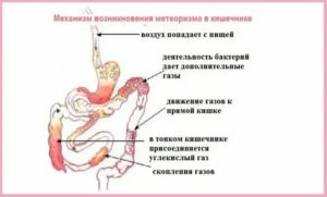 Что такое метеоризм кишечника у новорожденных