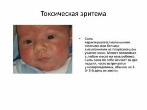 Когда у новорожденного проходит токсическая эритема