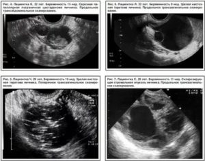 Что такое анэхогенное образование в яичнике у новорожденных
