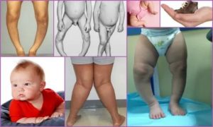 Что делать если у новорожденного кривые ноги