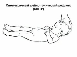 Что такое тонический шейный рефлекс новорожденного