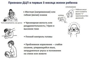 Как распознать первые признаки дцп у новорожденных