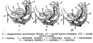 Как зачать если матка в anteflexio