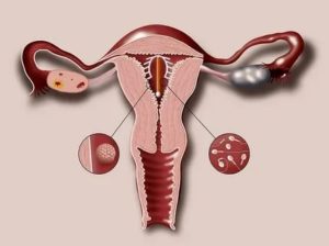 Как работает спиралька против зачатия
