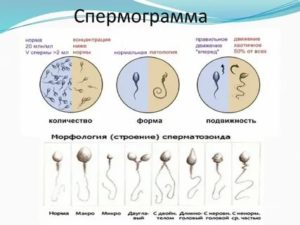 Можно ли при плохой спермограмме беременеть