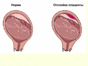 Как правильно лежать при отслойке плодного яйца