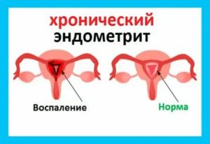 Как планировать беременность при хроническом эндометрите