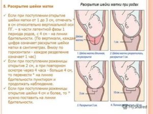 Что делать чтобы матка быстрее раскрылась и начались схватки