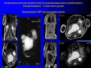 Что такое каликоэктазия почки у новорожденного