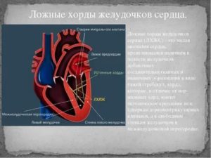 Что такое дополнительная хорда в сердце у новорожденных