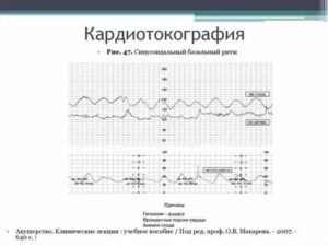 Как проводится ктг при двойне