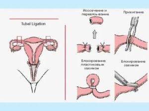 Можно ли сделать стерилизацию после родов женщине