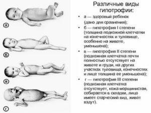 Что такое гипотрофия 1 степени у новорожденного