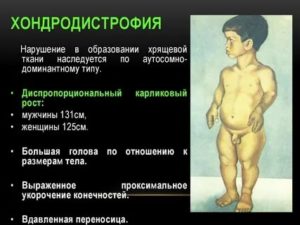 Что такое хондродистрофия плода