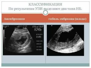 Когда можно планировать беременность после анэмбрионии