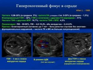 Что такое гиперэхогенный фокус в полости левого желудочка сердца у плода