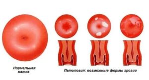 Можно ли беременеть с эктропионом шейки матки