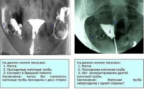 Когда после гистеросальпингографии можно планировать беременность