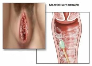 Может ли быть хроническая молочница причиной бесплодия