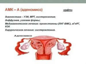 Чем лечить аденомиоз при планировании беременности