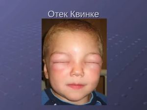 Может ли у грудничков быть отек квинке