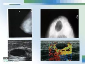 Может ли киста грудной железы перерасти в рак