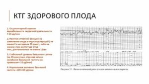 Что означает ктг плода подозрительная