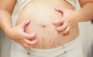 Почему чешется живот после родов