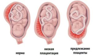 Когда поднимается плацента при низкой плацентации какие ощущения