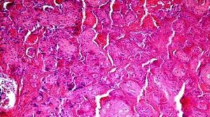 Что такое тромбоз в плаценте