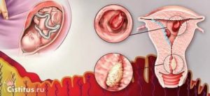 Как полип в матке влияет на зачатие и беременность