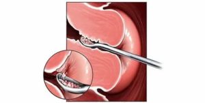 Как делают выскабливание при плацентарном полипе