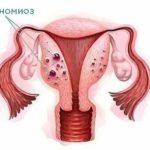 Как нарастить эндометрий для зачатия быстро после выскабливания