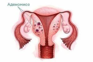 Чем лечить аденомиоз при планировании беременности